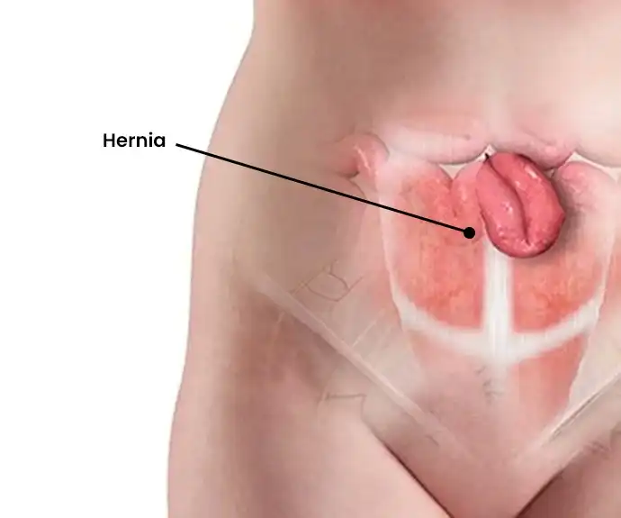 umbilical hernia